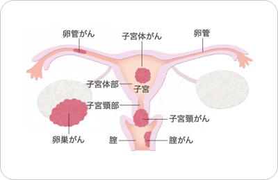 図：子宮の構造と女性性器がんの種類