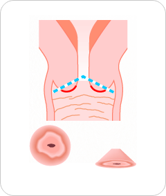 図：円錐切除術の切り取り部位