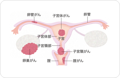 図:子宮の構造と女性性器がんの種類